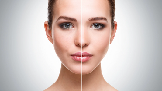 Acne Soap Bar: Your Daily Defence Against Breakouts