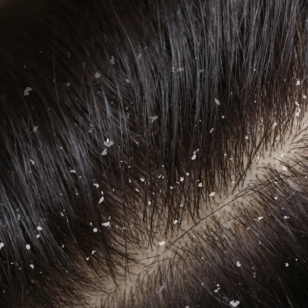 Itchy Scalp & Dandruff