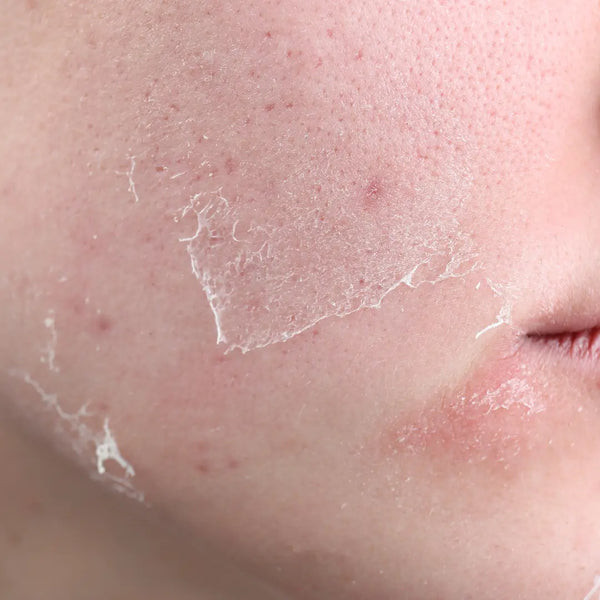Dry Skin