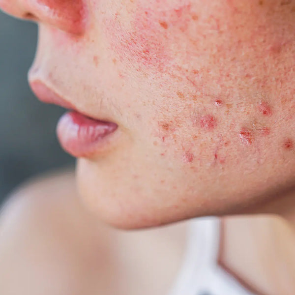 Sensitive Skin & Redness